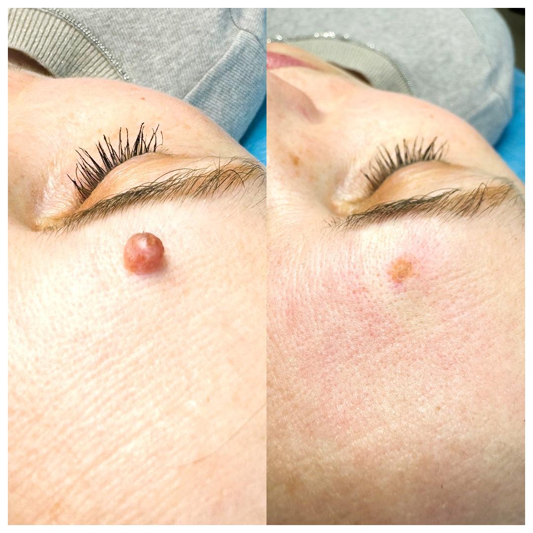 удаление родимки лазером SENSAVI